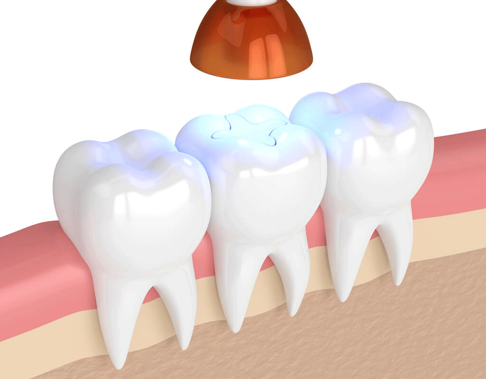 blue light being applied to a tooth colored filling